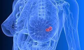 Breast Cancer Treatment