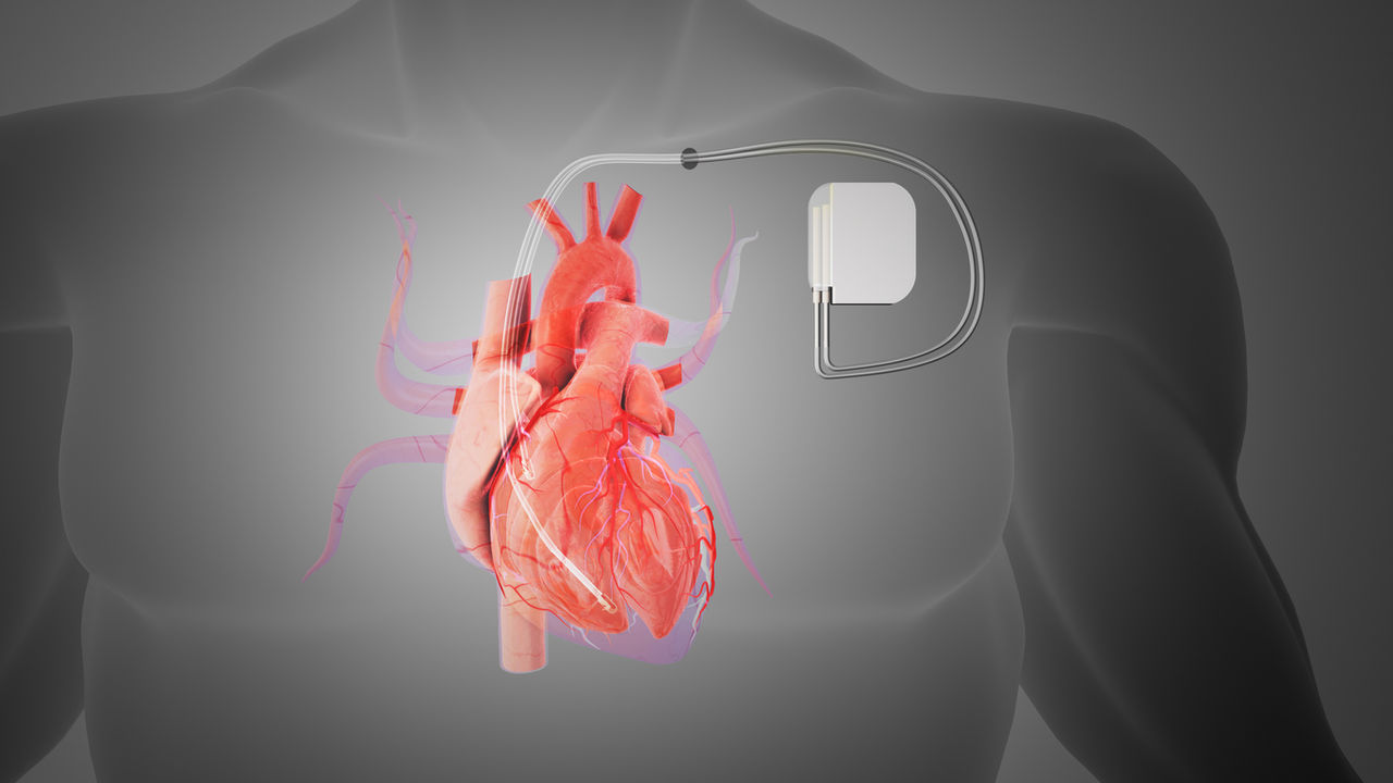 Biventricular Pacemaker Surgery