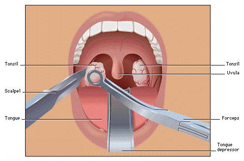 Adenotonsillectomy