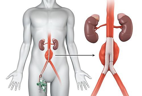 EVAR (Endovascular aneurysm repair)