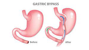 Gastric Bypass