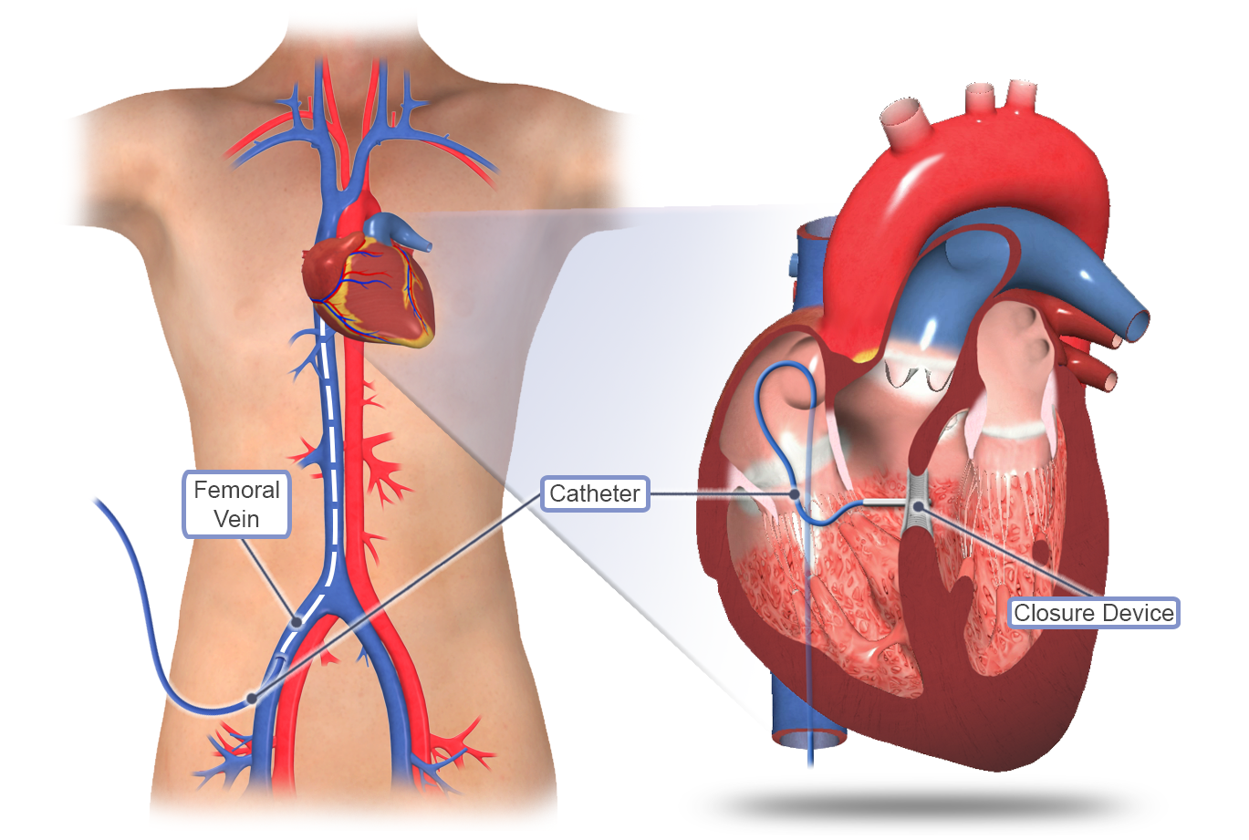 VSD Surgical Closure Open Surgery