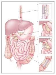 Self Expending Metal Stents