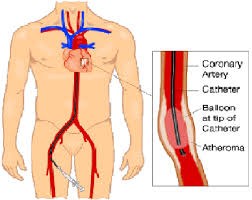 Angioplasty PTCA