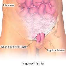 Herniorrhaphy - Inguinal - Unilateral