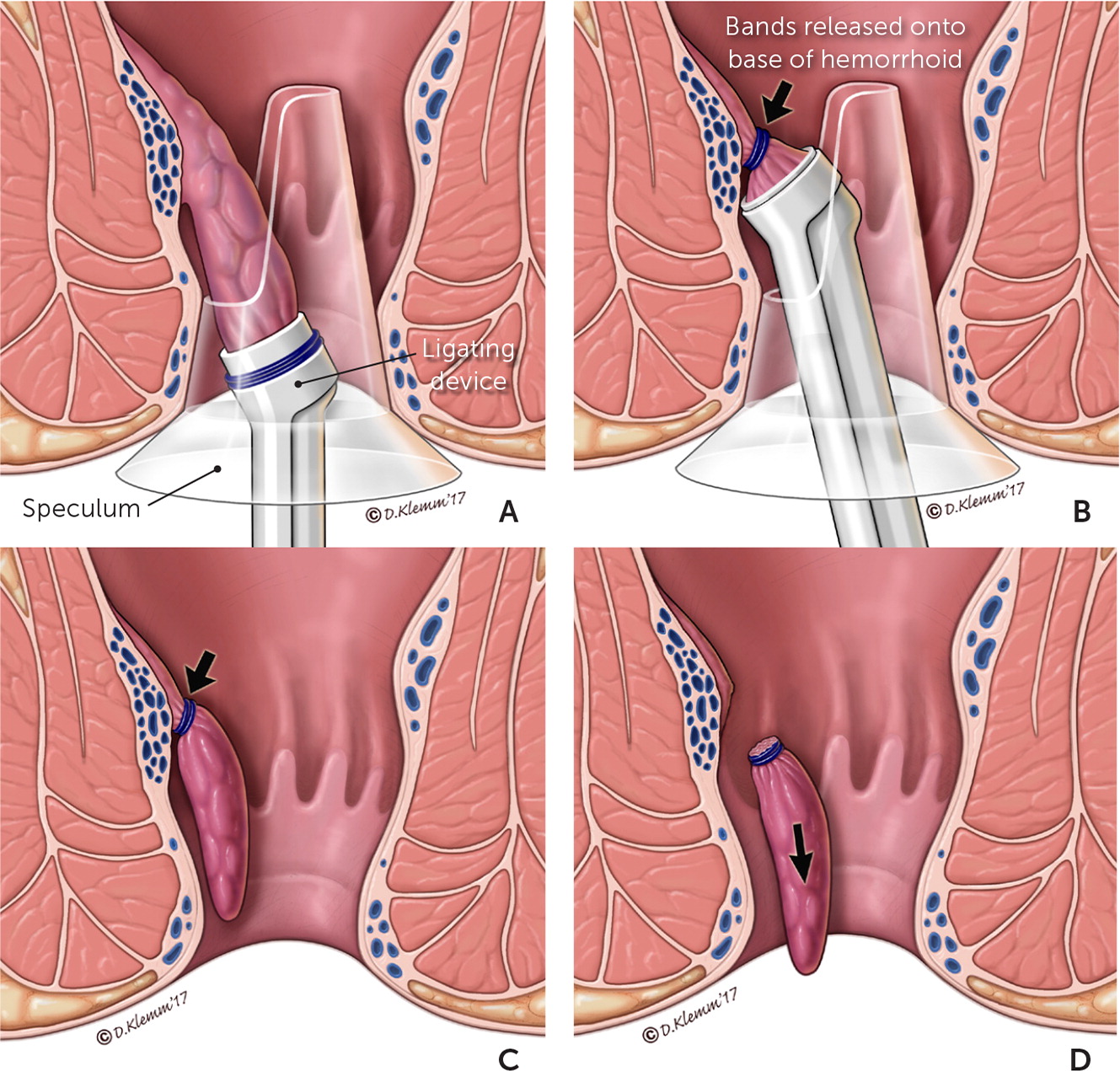 Haemorrhoidectomy - Routine