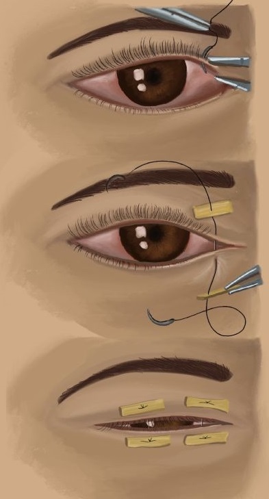 ORBIT AND OCULOPLASTY Tarsorrhaphy Single Eye