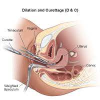 D & C With Hysteroscopy