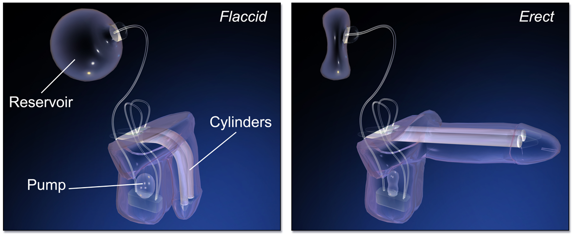 Erectile Dysfunction Inflatable Penile Implant or Prosthesis