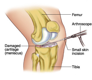 Arthroscopic Meniscal Repair