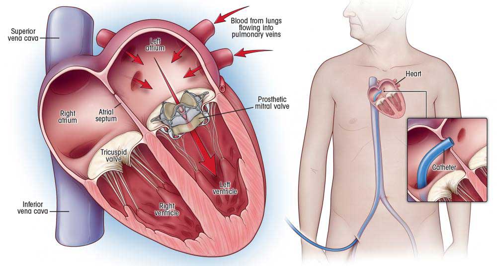 Double Valve Replacement and CABG