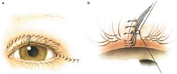 ORBIT AND OCULOPLASTY Lid tear repair Single Eye