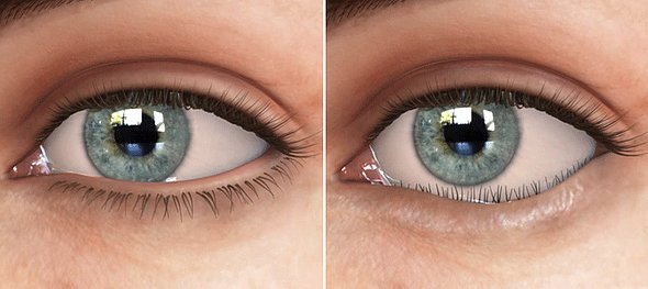 ORBIT AND OCULOPLASTY Entropion Surgery Per Lid Single Eye