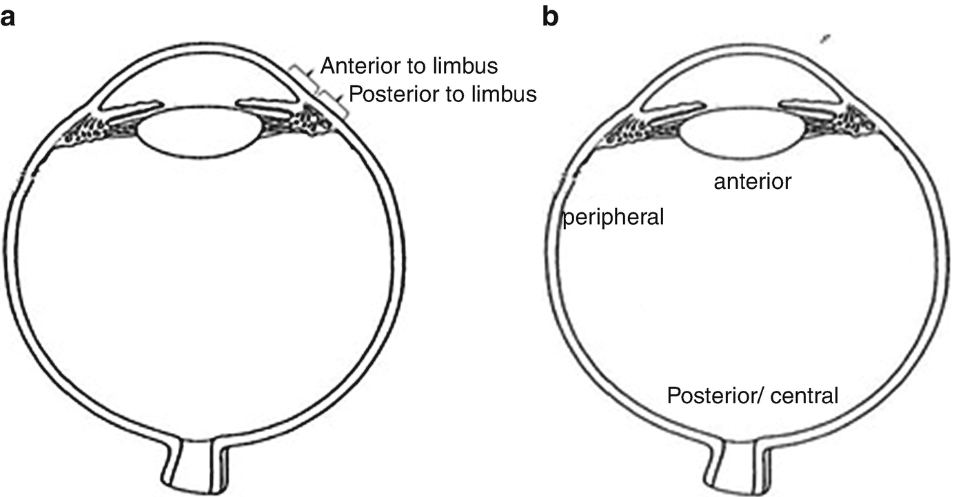 VITREO RETINAL PROCEDURES Pars Plana Viterctomy 25G for Single Eye