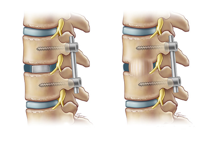 Tlif ii Level With Decompression