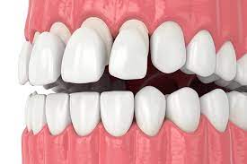 Smile Design Procedure Composite Veneers