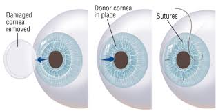 Cornea Transplant