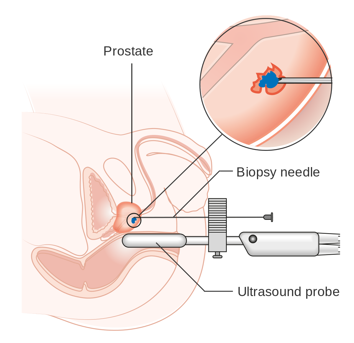 Prostate Biopsy