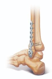 Implant Removal Major