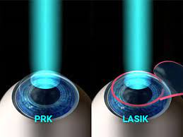 REFRACTIVE SURGICAL PROCEDURE-PRK (Both Eyes)