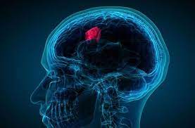 Brain Cancer treatment