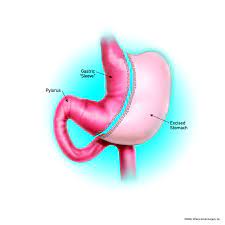 Lap Sleeve Gastrectomy