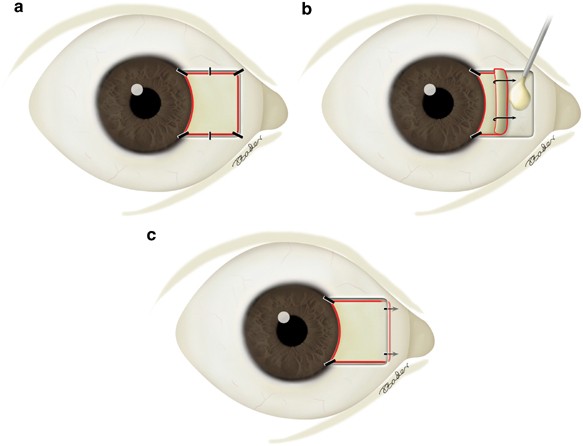 CORNEAL AND OCULAR SURFACE PROCEDURES-Pterygium excision with autograft with fibrin glue- Single Eye