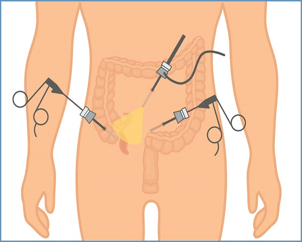 Appendectomy