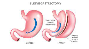 Sleeve Gastrectomy