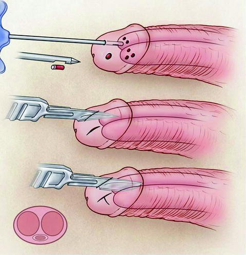 Caverno Saphenous Shunt Priapism