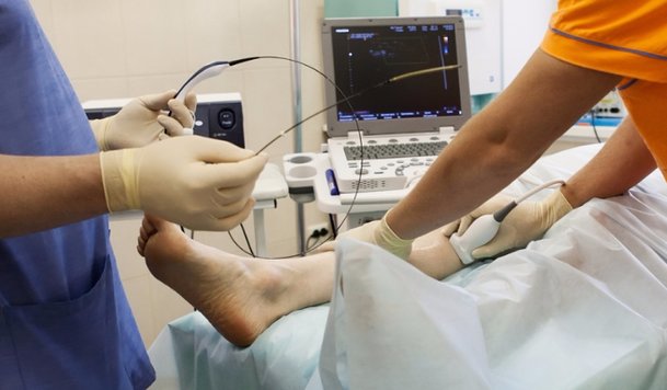 Varicose Veins Single Laser or RFA