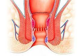 Stapler Haemorrhoidectomy