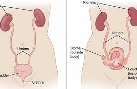 Laparoscopic Radical Cystectomy