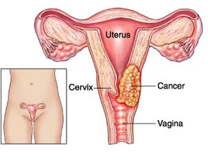 Cervical Cancer Treatment