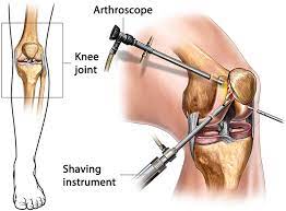 Arthroscopy