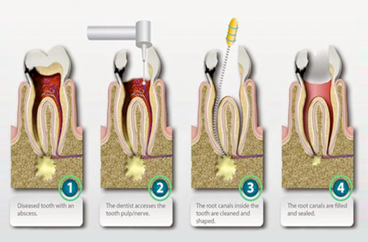 Root Canal Treatment