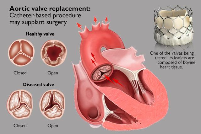 Aortic Valve Replacement