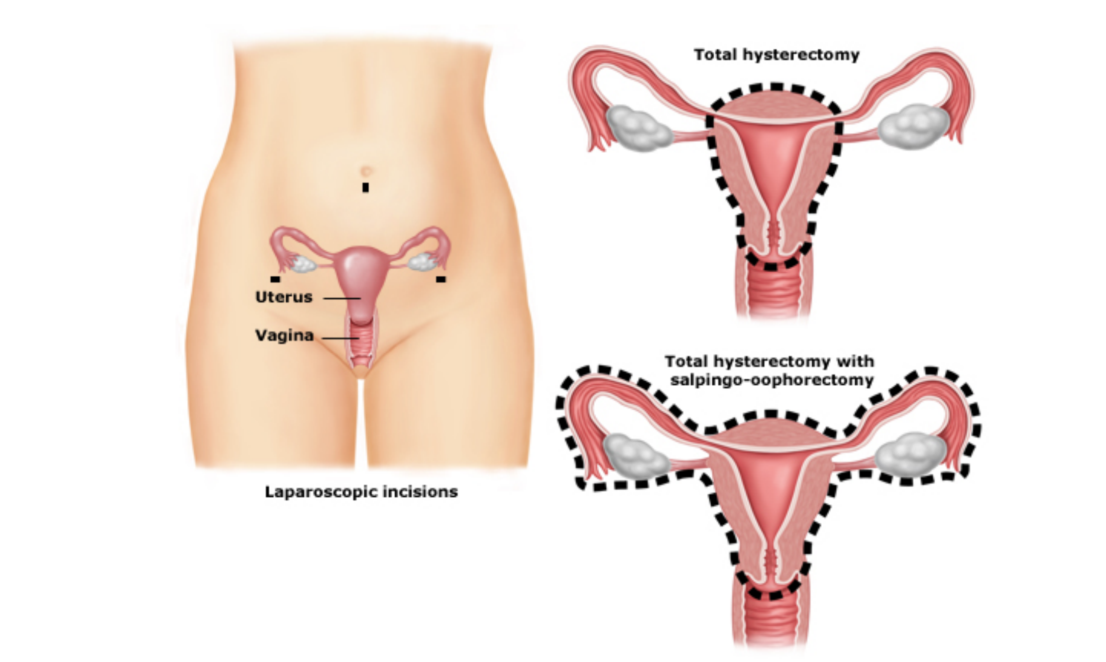 Hysterectomy Abdominal With Or Without Bso