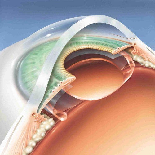 CATARACT Phaco with 3 Piece monofocal PCIOL Single Eye