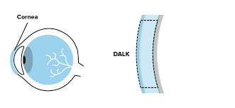 CORNEAL AND OCULAR SURFACE PROCEDURES-DALK- Deep anterior lamellar Keratoplasty- Single Eye