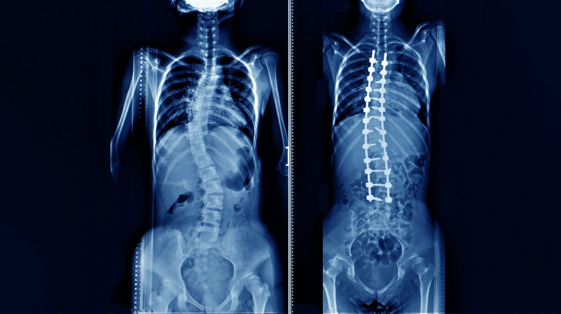 Scoliosis Correction Complex