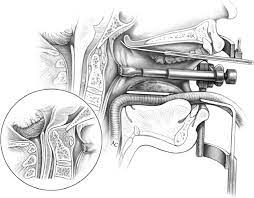 Spine Transoral Decompression