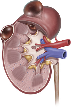 Laparoscopic Renal Cyst Excision