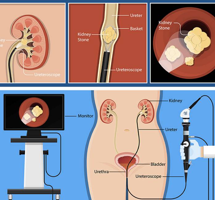 Ursl Lithotripsy