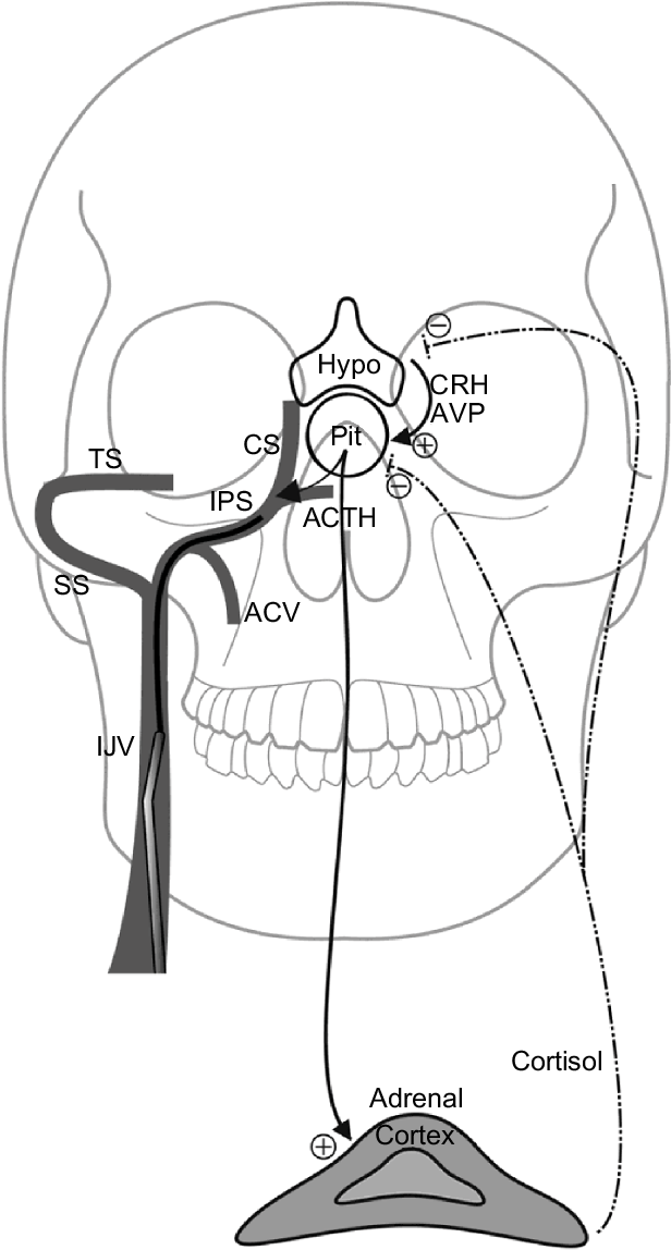 IPSS (Inferior petrosal sinus sampling)