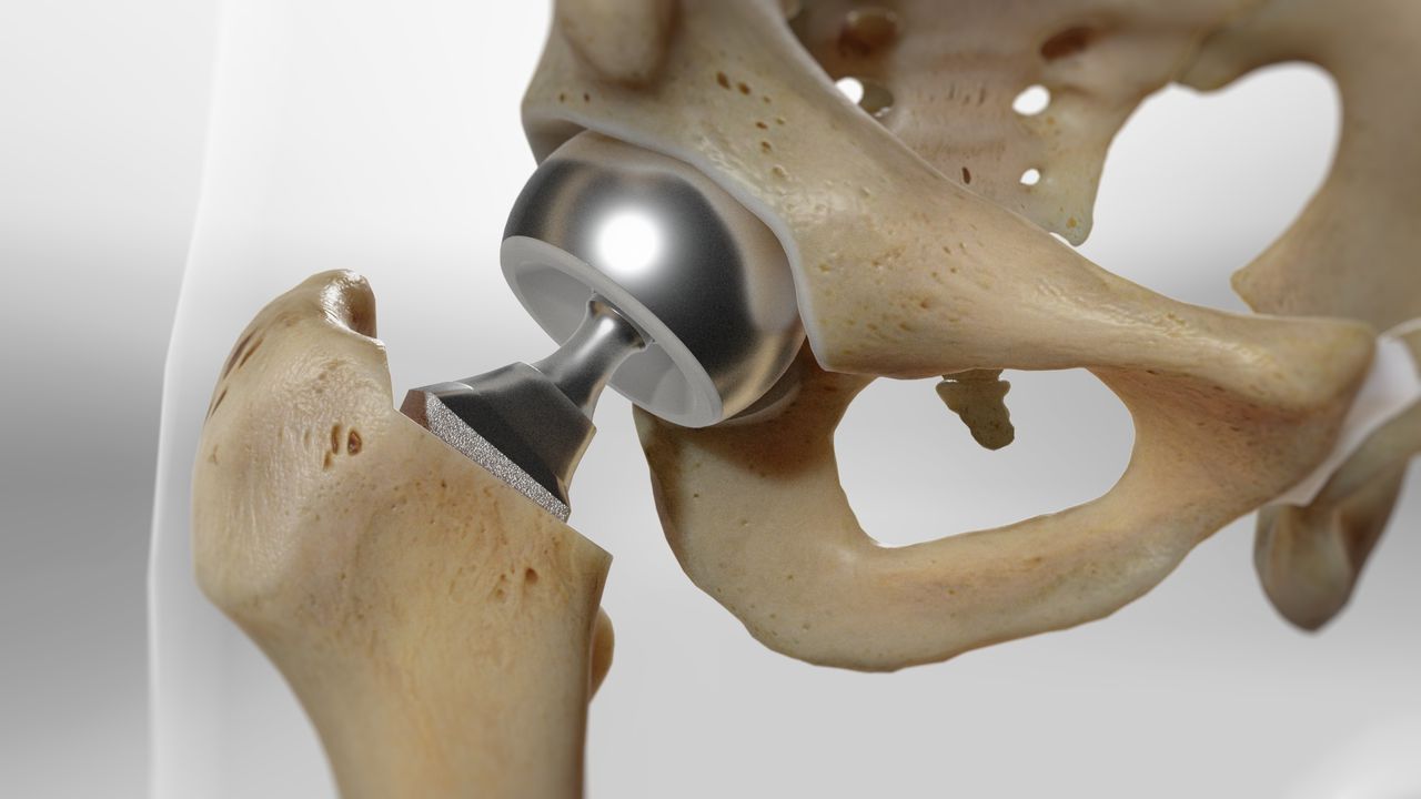 Bipolar Hemiarthroplasty
