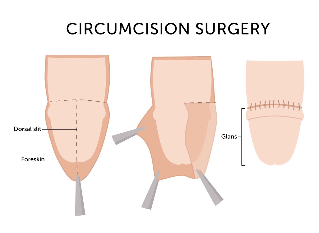 Circumcision