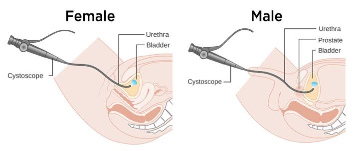 Cystoscopy & Dj Stent Insertion