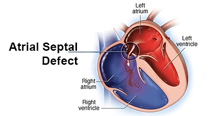 Atrial Septal Defect (ASD) Repair