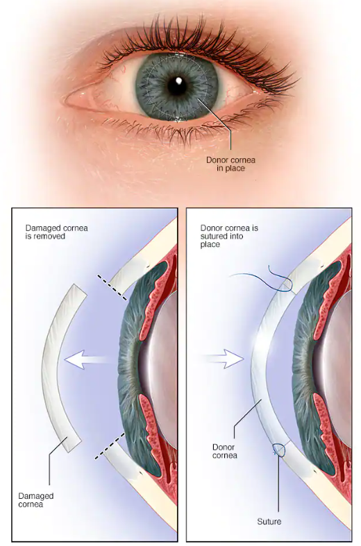 Cornea Transplant
